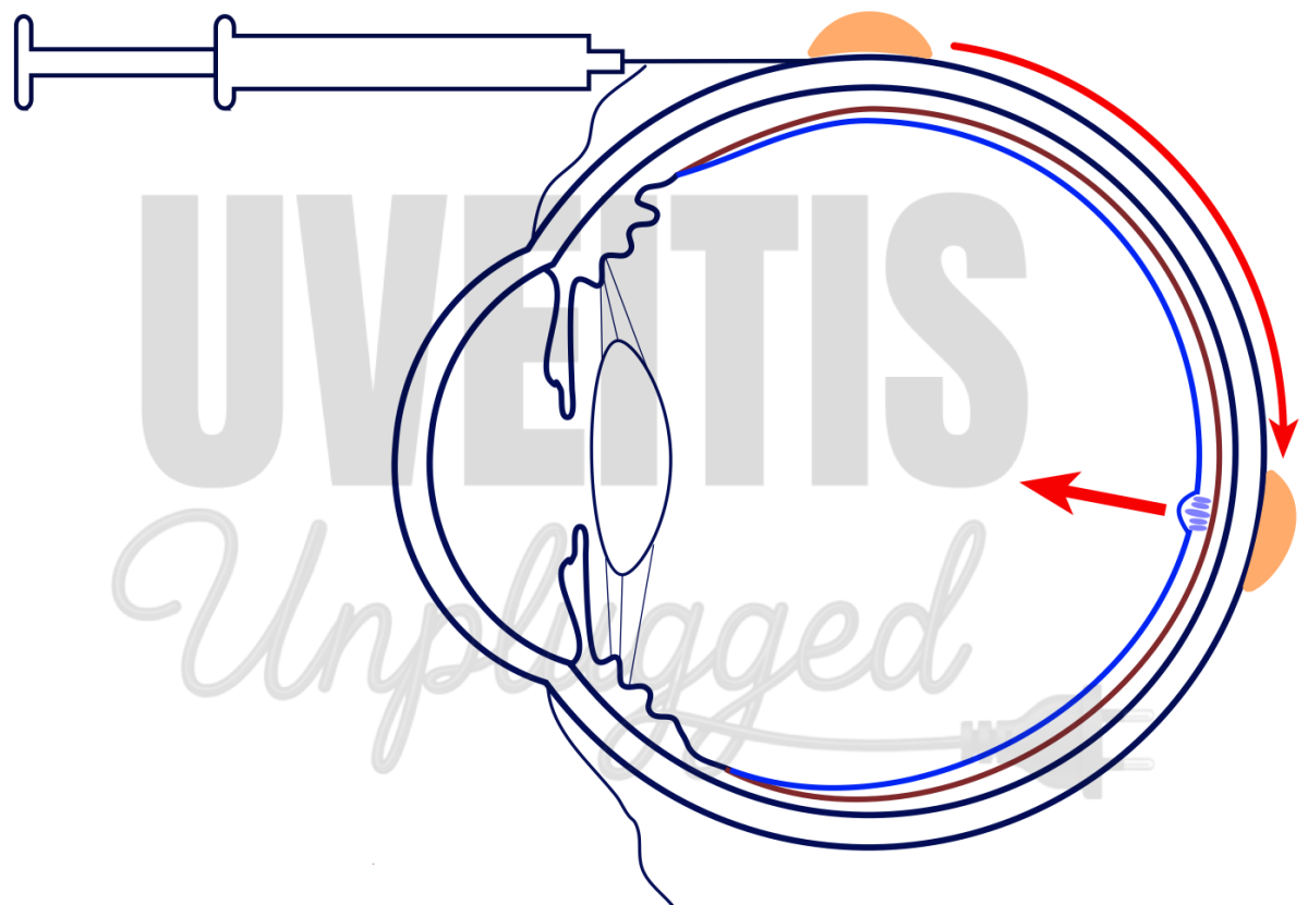 Periocular Corticosteroid