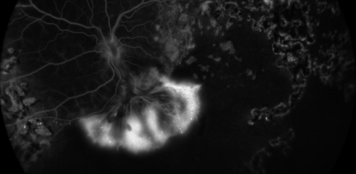 Neovascularization in Ocular Inflammation