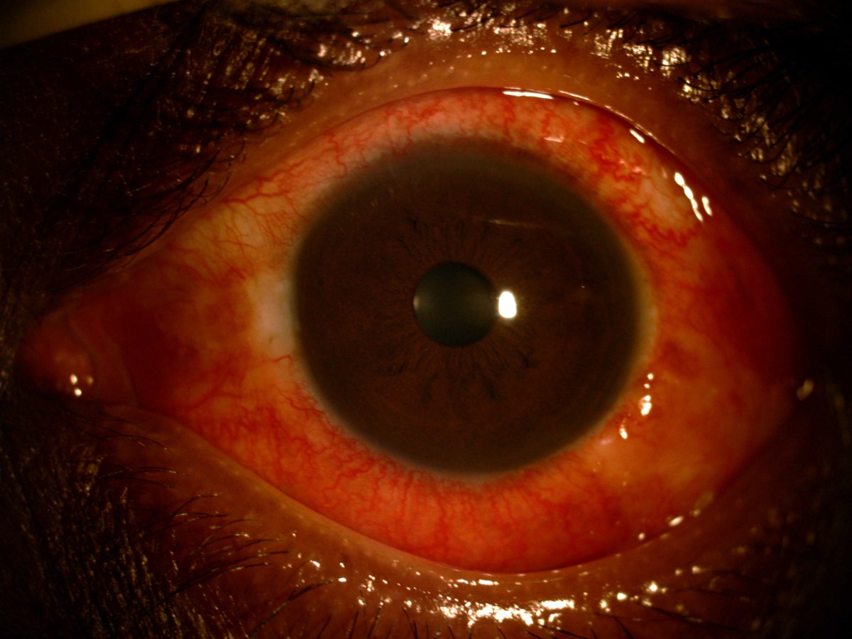 Clinical Approach to a Case of Uveitis