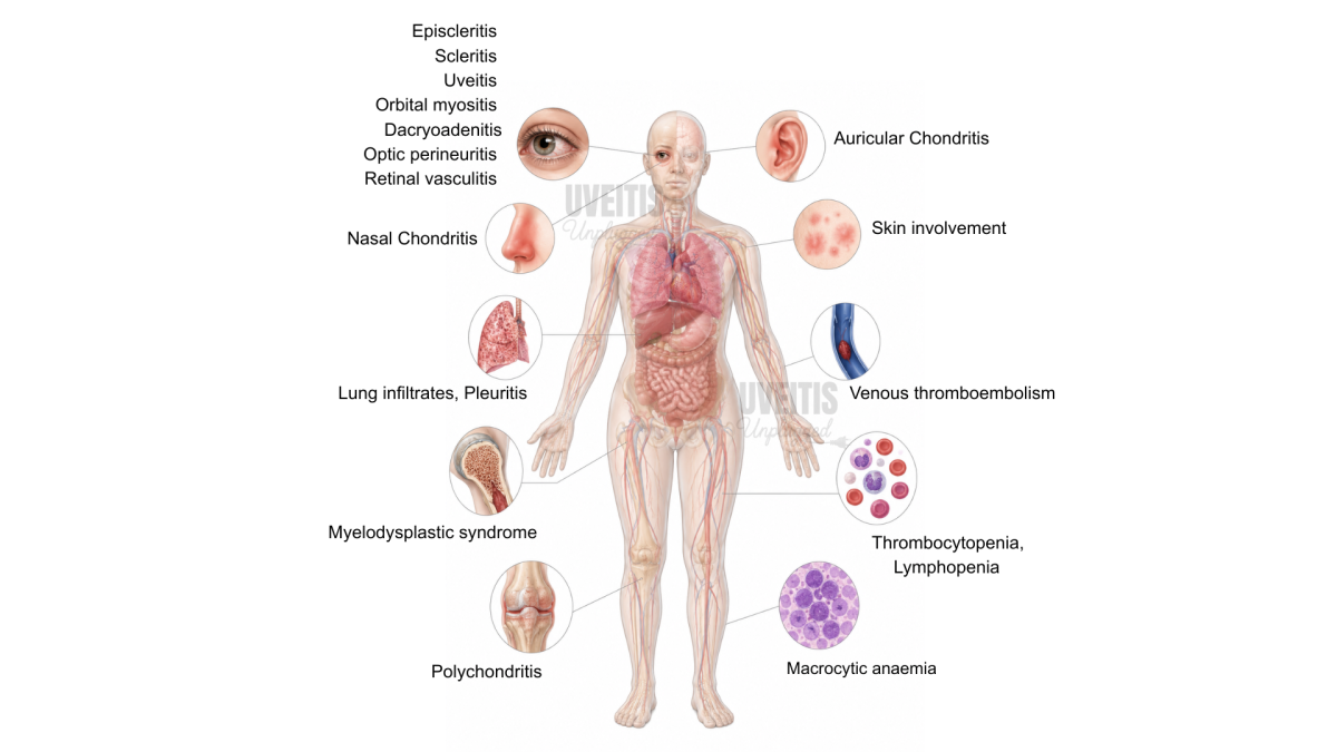 VEXAS Syndrome: Every Ophthalmologist Must Know