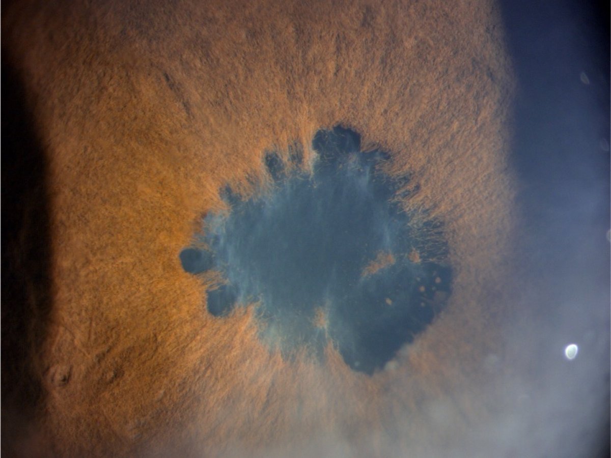 Managing Cataract in Children with Uveitis : A Challenge